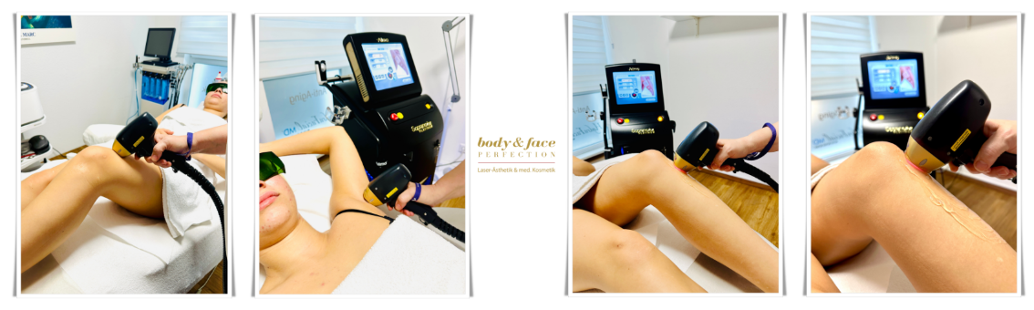 Dauerhafte Haarentfernung mit dem Dioden Laser. Reutlingen body and face Perfection